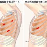 自然気胸に対するブラ切除術（縫縮術ではない！）