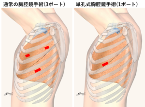 自然気胸に対するブラ切除術（縫縮術ではない！）