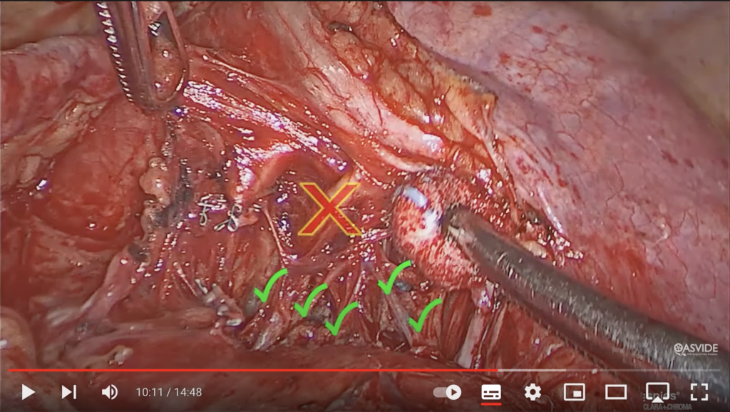 左縦隔郭清その２（YouTube動画で勉強）