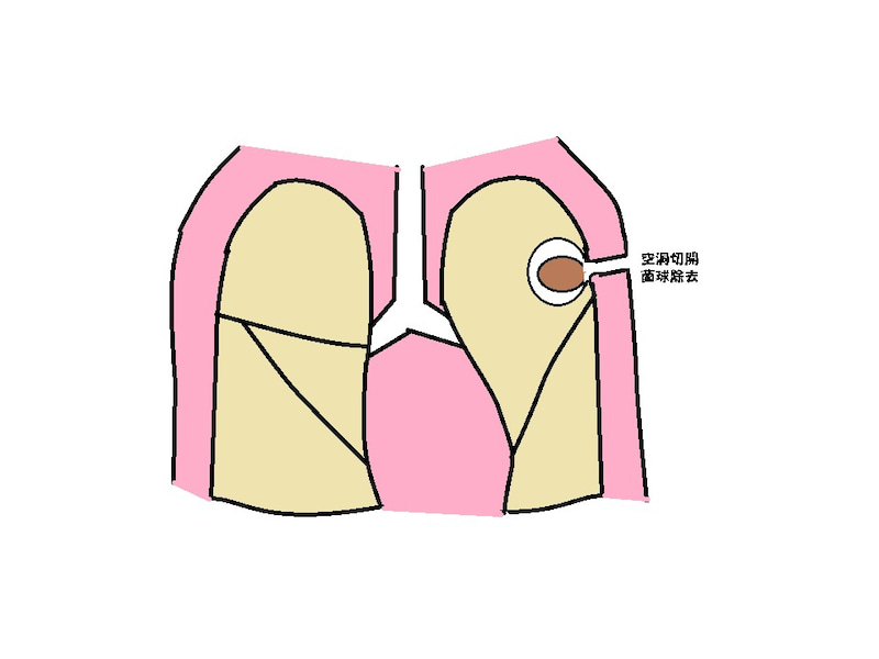肺アスペルギルス症（PA）