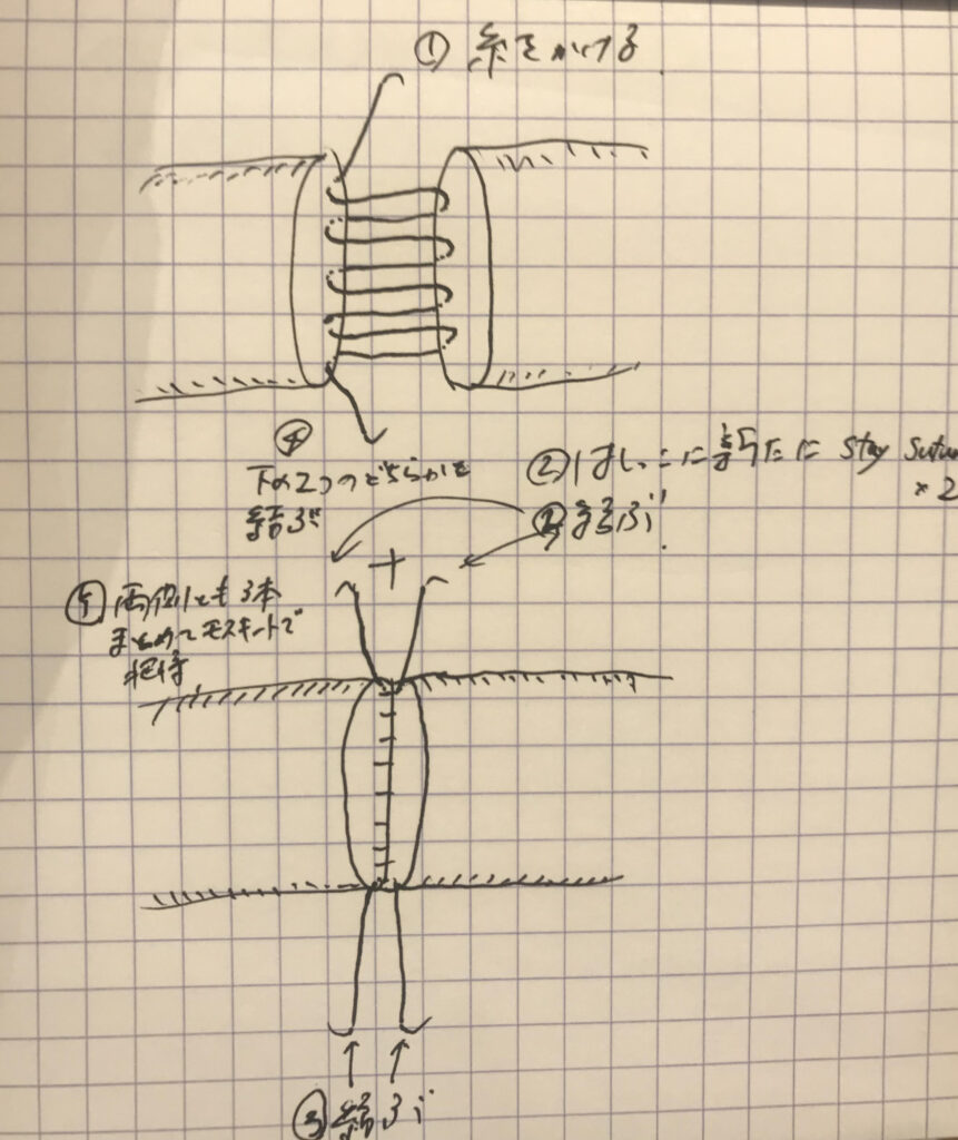 気管支形成（吻合）(＝2024/6/14追記：両端内外単結節で！）