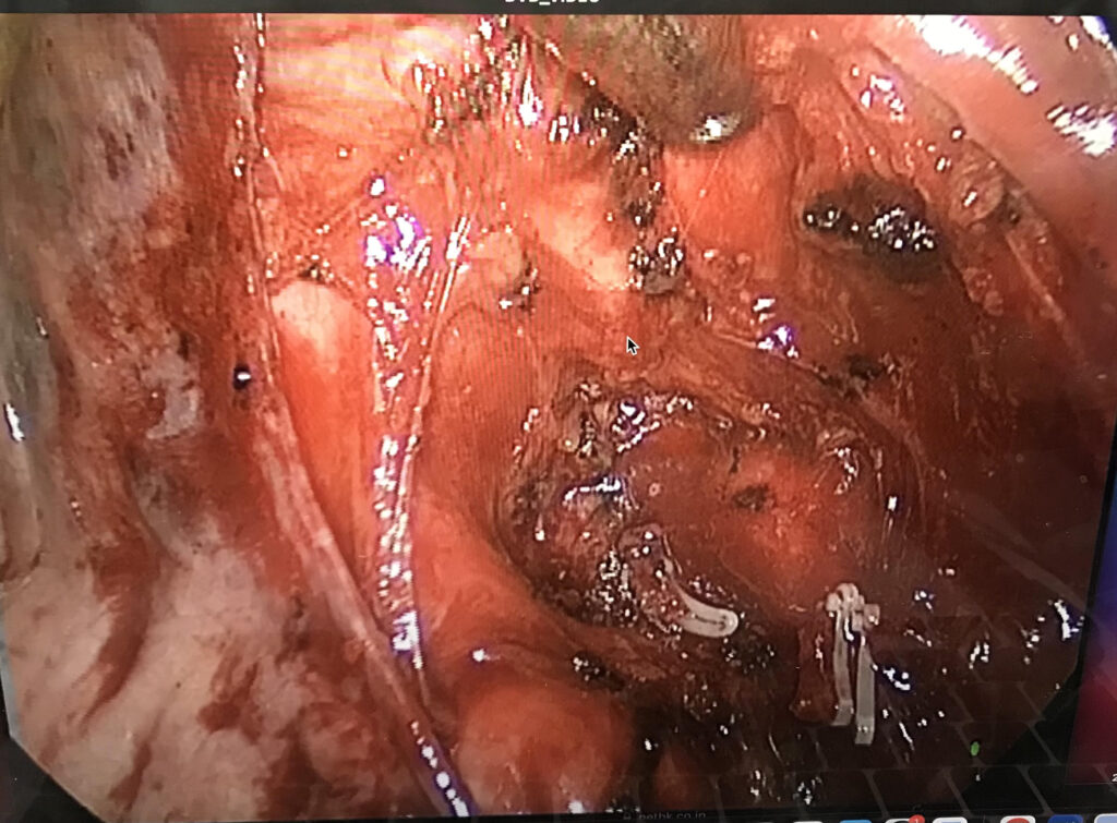 【解決】左反回神経、マジでわかんないんだが。