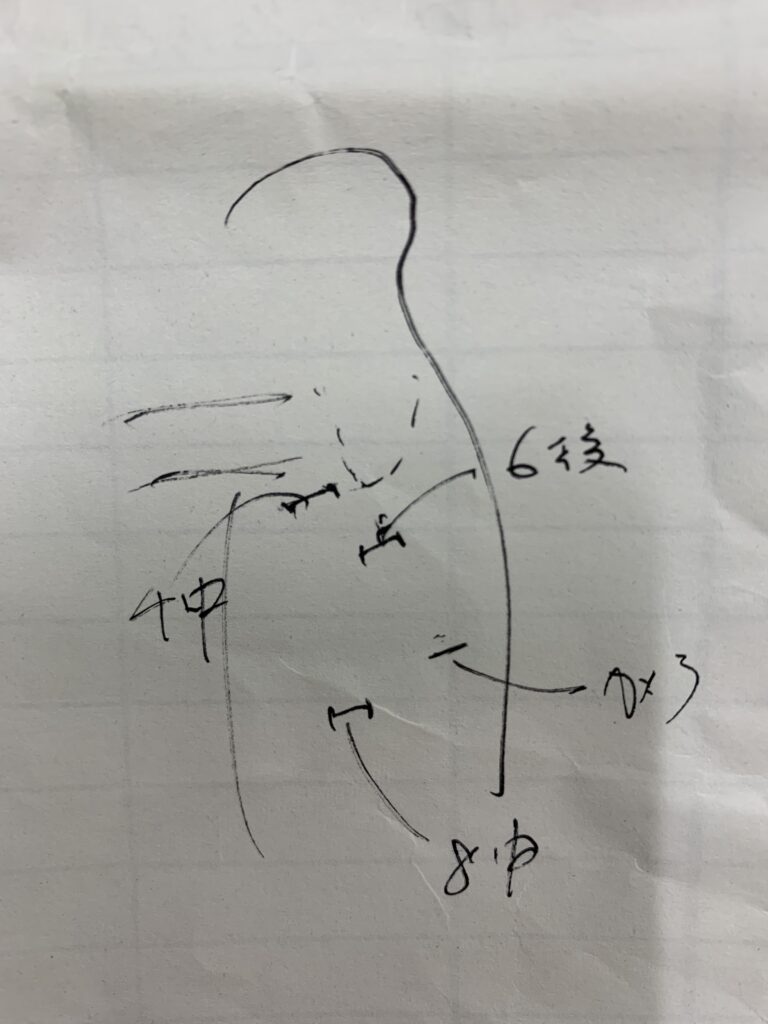 横隔膜弛緩症