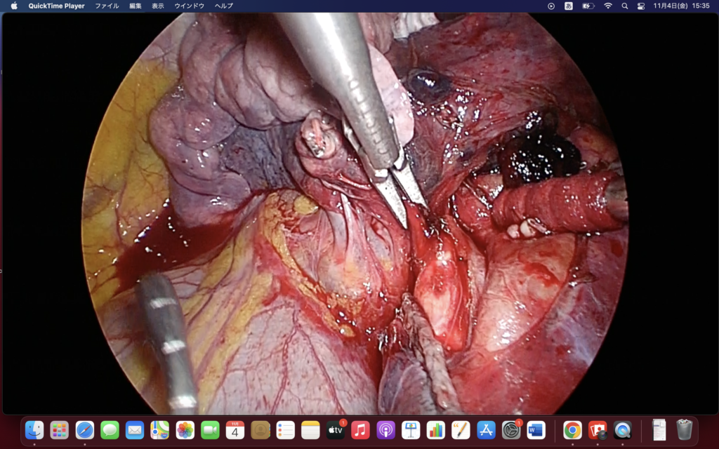 (VATS)左上葉切除