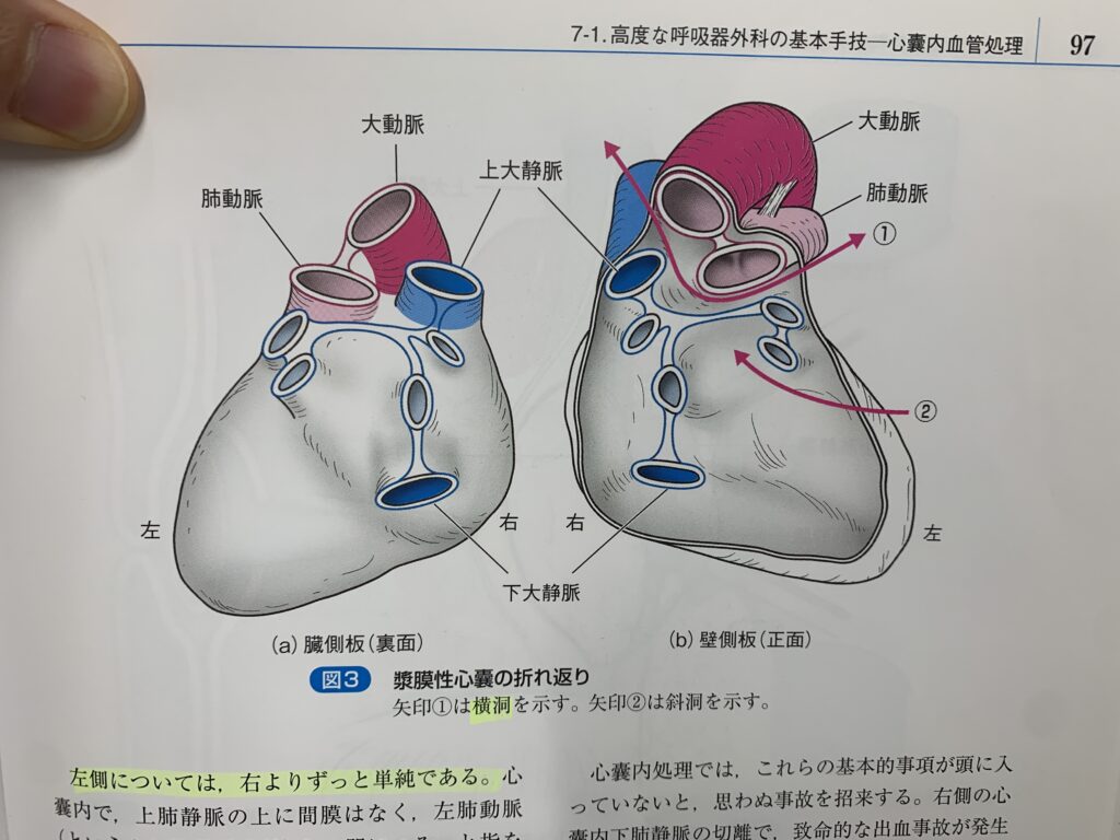 心嚢内での血管確保・・・奥が深い！！＝目的は、肺門の癒着（または固着）が激しい症例や、あとは出血を止めるための緊急の心嚢内血管確保（2024/1/15タイトル補足）