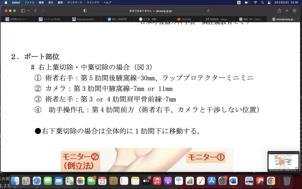 開胸手術における術者の立ち位置〜術者は基本、麻酔科から見て右〜
