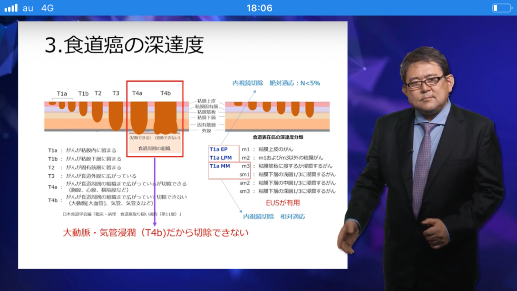 食道癌＝過去問やり込むノウハウ必要！解説の活用大事。パワポとプリンタ使うのが吉。