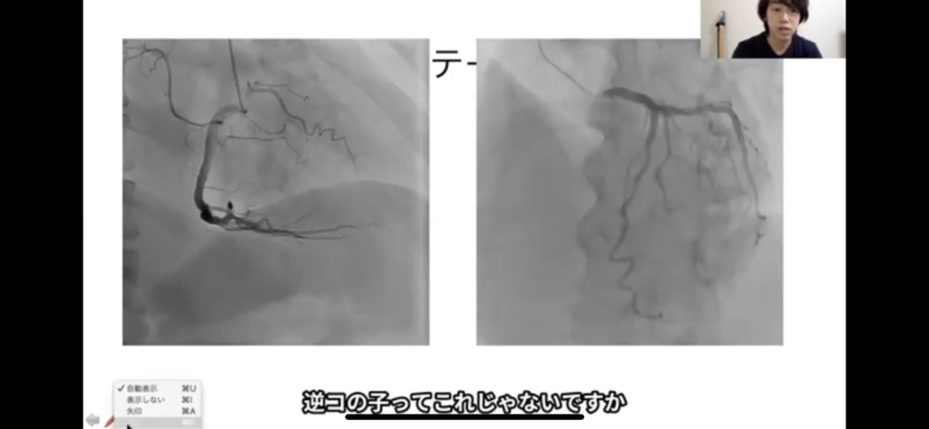 冠動脈造影（CAG）の読み方=例96016936