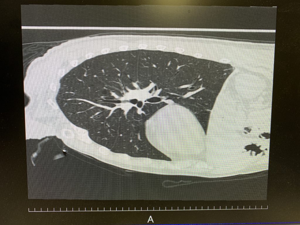 新しいCTの回転法