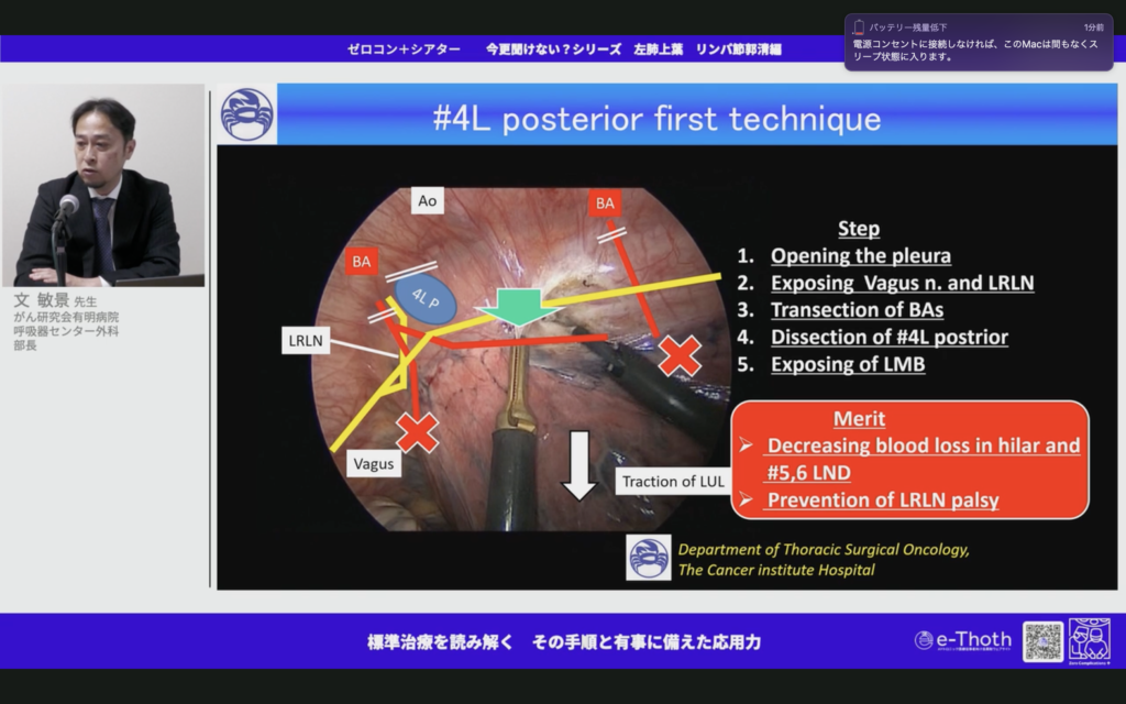 左上葉切除のリンパ節郭清＝癌に嗤われない手術を