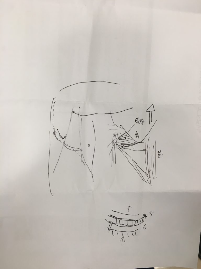 開胸の考え方(6/17追記；10/1追記)＝含後側方切開（2025/01/26追記）