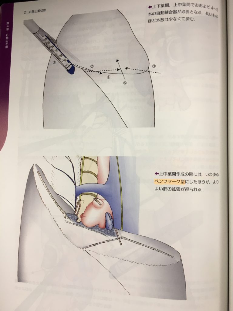 fissureless lobectomy