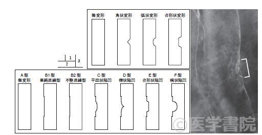 注腸の読み方：壁変形＝ちょっと分かってきた笑