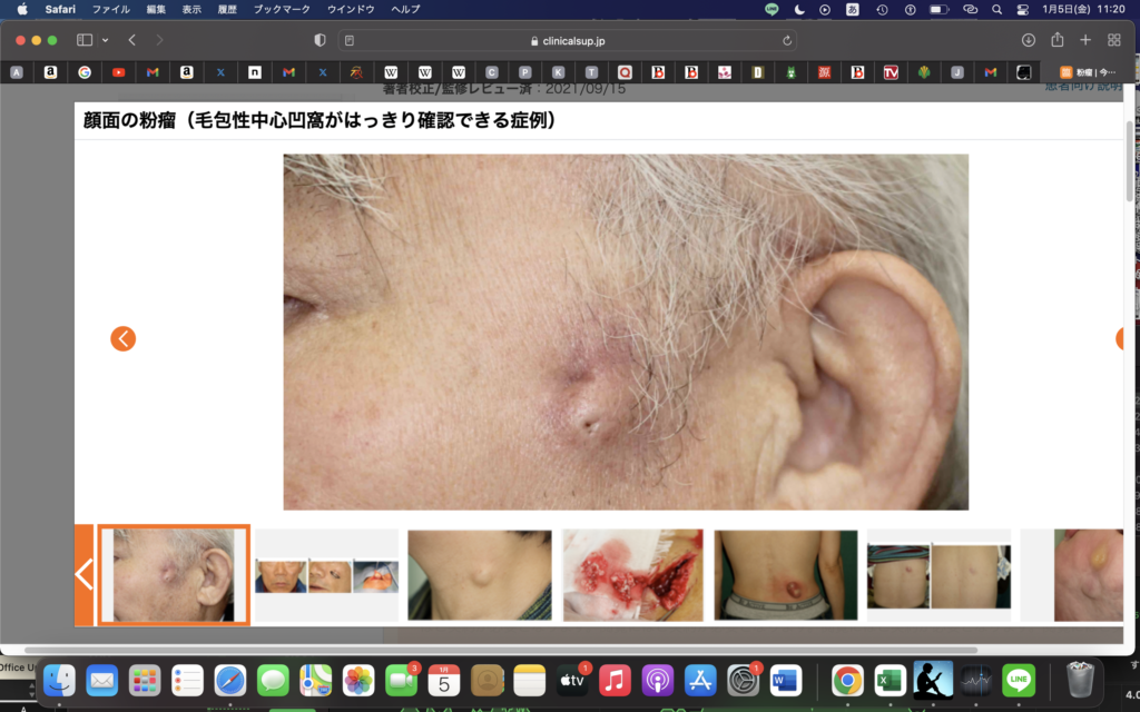 粉瘤と脂肪腫の違い