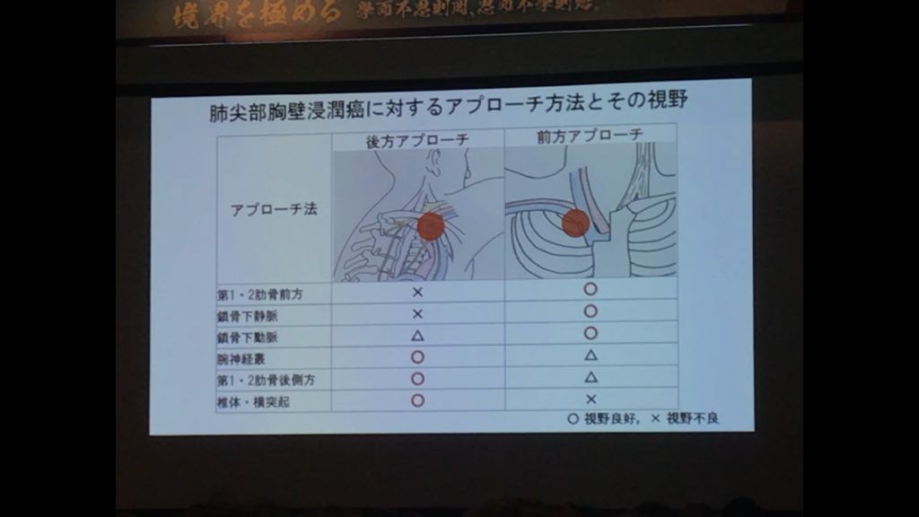 呼吸器外科学会渡辺俊一先生のセミナー＝SSTの治療などについて