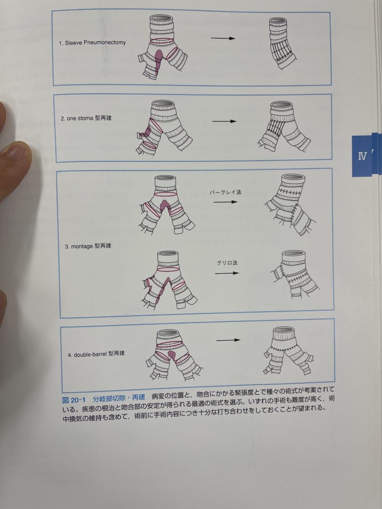 気管分岐部再建（T4症例の手術）