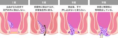主訴「肛門が痛い」への対応＝お尻から血がでる、便と一緒に血がでる、の対応も同じ。