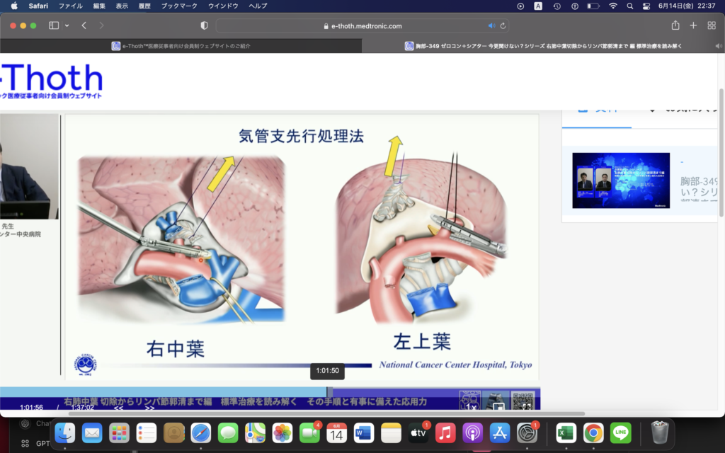 中葉スリーブ＝中下葉切除を避けたい！＝月曜日にやる予定＝ていうかカルチノイドってリンパ節郭清いるの？→する予定;ND2a-2＝気管支鏡所見見ろ！