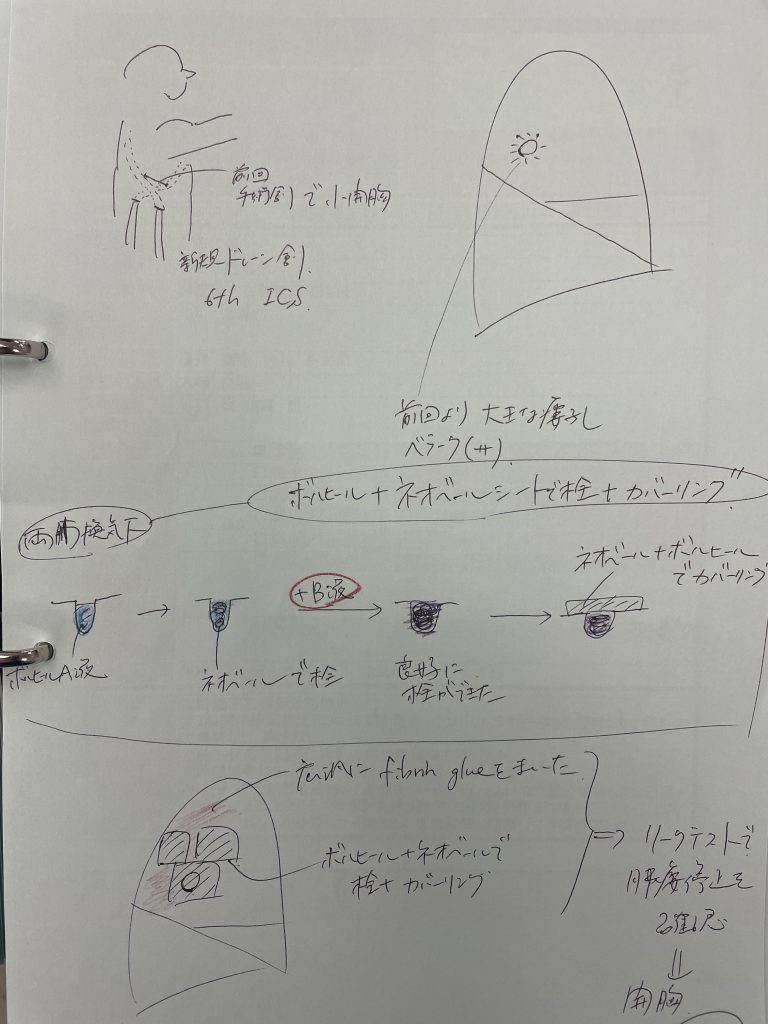 肺瘻閉鎖の奥義＝物理法則（オームの法則、ベルヌーイの定理）からも考える