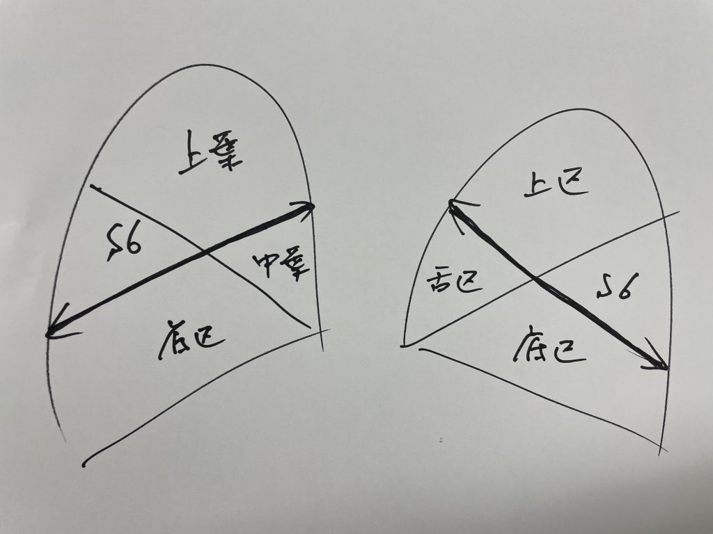 区域間切離の難しさ＝区域切除のニーズは高い