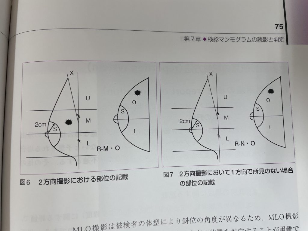 マンモグラフィーの位置記載
